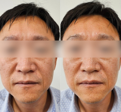 全面部紧致提升案例